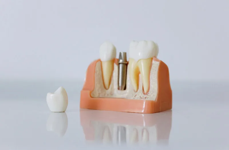 All-on-4 Implants information